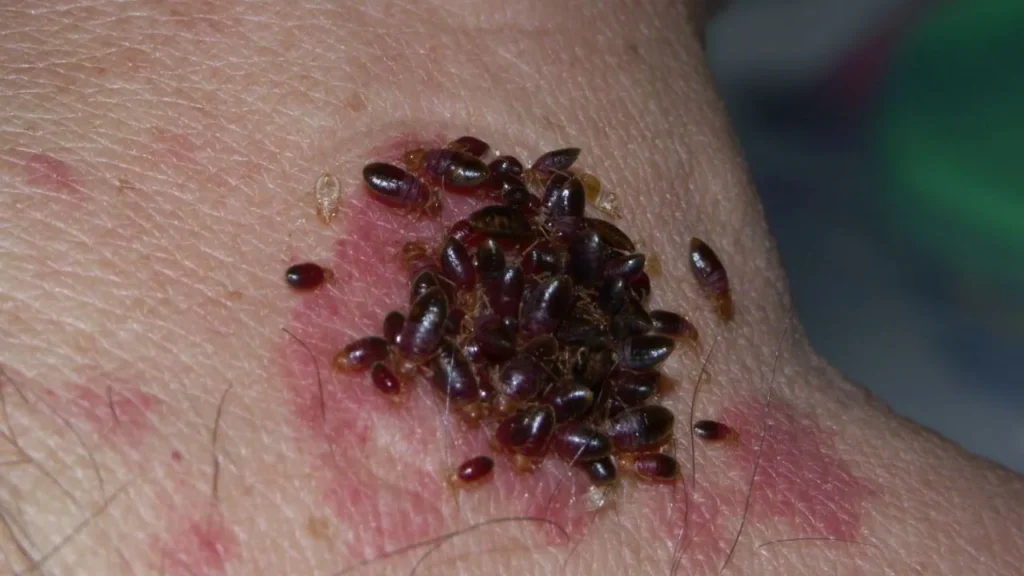 Bed bug bites